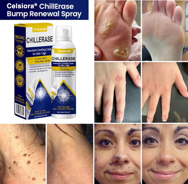 ❤️ Celsiora® ChillErase Kühlspray für Hautanhängsel 🇩🇪