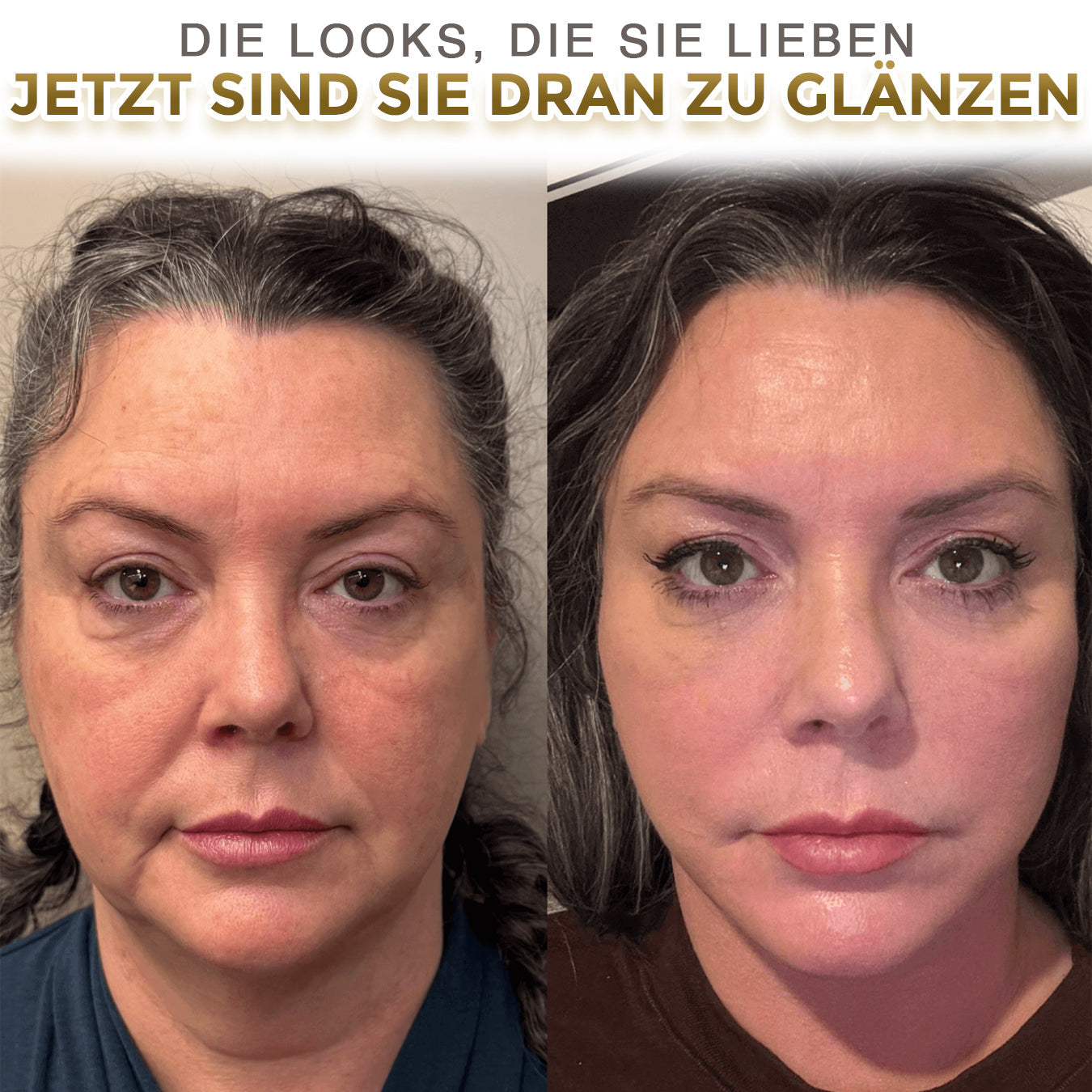 Aphine® Augenroller gegen Schwellungen | Entfernt 97 % der Tränensäcke in 60 Sekunden – lässt Sie sofort 10 Jahre jünger aussehen!