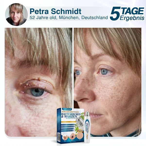🇩🇪 CareBreeze® Fortschrittlicher Stielwarzen- & Warzenentfernerstift 🧑🏼‍⚕️