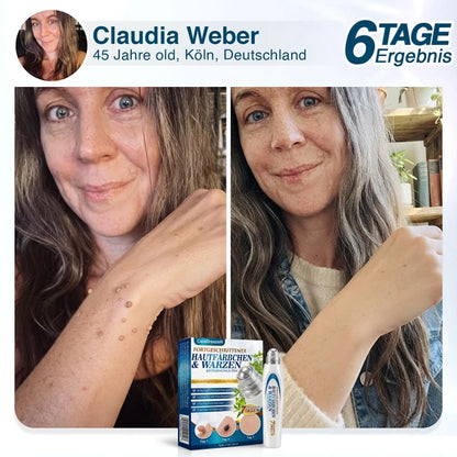🇩🇪 CareBreeze® Fortschrittlicher Stielwarzen- & Warzenentfernerstift 🧑🏼‍⚕️