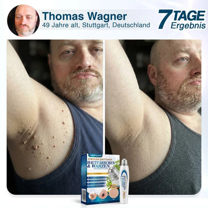 🇩🇪 CareBreeze® Fortschrittlicher Stielwarzen- & Warzenentfernerstift 🧑🏼‍⚕️