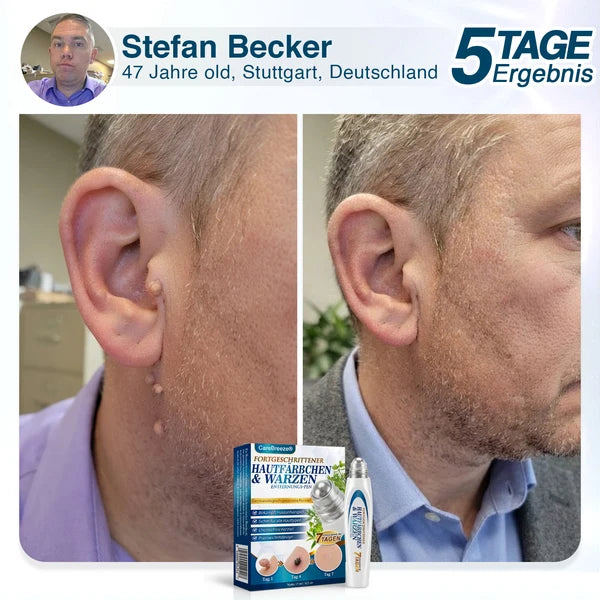 🇩🇪 CareBreeze® Fortschrittlicher Stielwarzen- & Warzenentfernerstift 🧑🏼‍⚕️