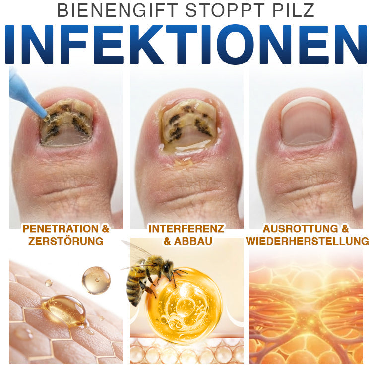 🇩🇪 CareBreeze® Fungi Free Bienengift-Nagelbehandlung 🧑‍⚕️