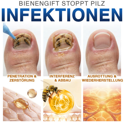 🇩🇪 CareBreeze® Fungi Free Bienengift-Nagelbehandlung 🧑‍⚕️