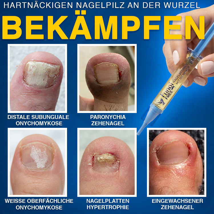 🇩🇪 CareBreeze® Fungi Free Bienengift-Nagelbehandlung 🧑‍⚕️