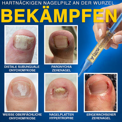 🇩🇪 CareBreeze® Fungi Free Bienengift-Nagelbehandlung 🧑‍⚕️