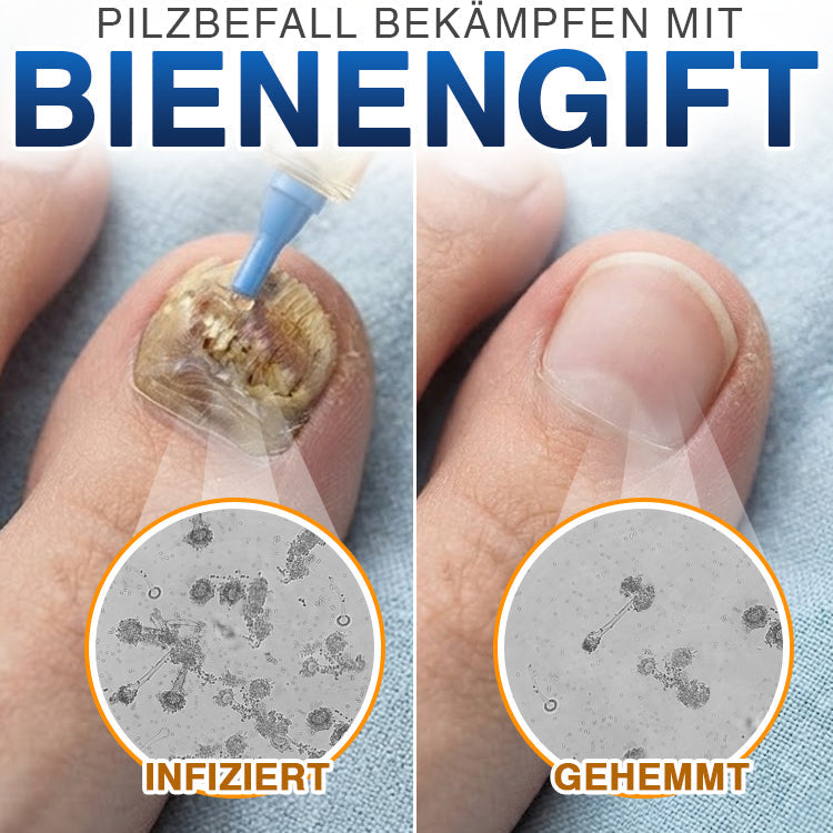 🇩🇪 CareBreeze® Fungi Free Bienengift-Nagelbehandlung 🧑‍⚕️