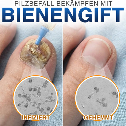 🇩🇪 CareBreeze® Fungi Free Bienengift-Nagelbehandlung 🧑‍⚕️