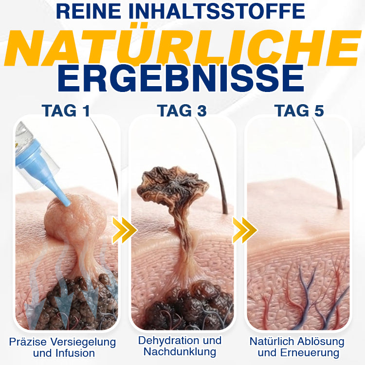 🇩🇪 CareBreeze® Anti-Stielwarzen-Präzisionsgel 🥼
