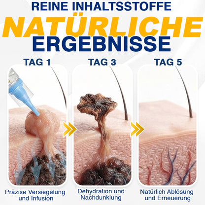 🇩🇪 CareBreeze® Anti-Stielwarzen-Präzisionsgel 🥼