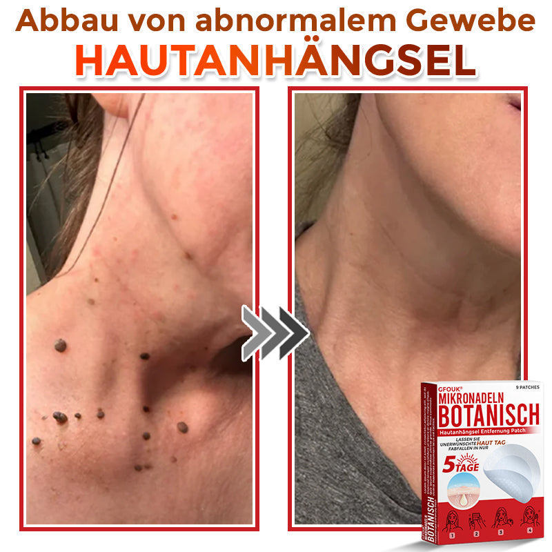 🇩🇪👨🏻‍⚕️ GFOUK® Mikronadel-Botanisches Hautanhängsel-Entfernungspflaster ✅