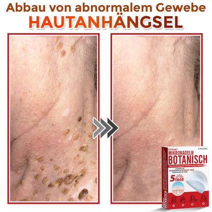🇩🇪👨🏻‍⚕️ GFOUK® Mikronadel-Botanisches Hautanhängsel-Entfernungspflaster ✅