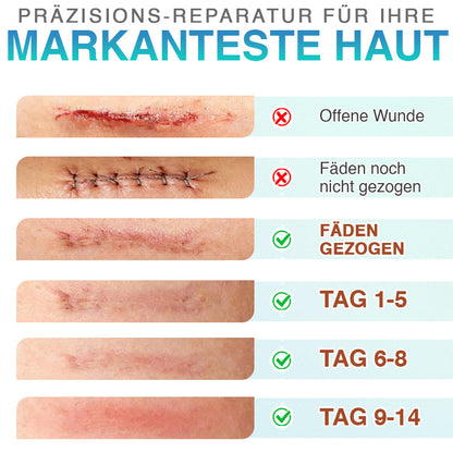 CareBreeze® Mikronadel-Pflaster zur Narbenpflege