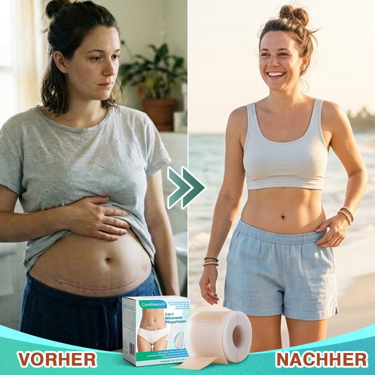 CareBreeze® Mikronadel-Pflaster zur Narbenpflege