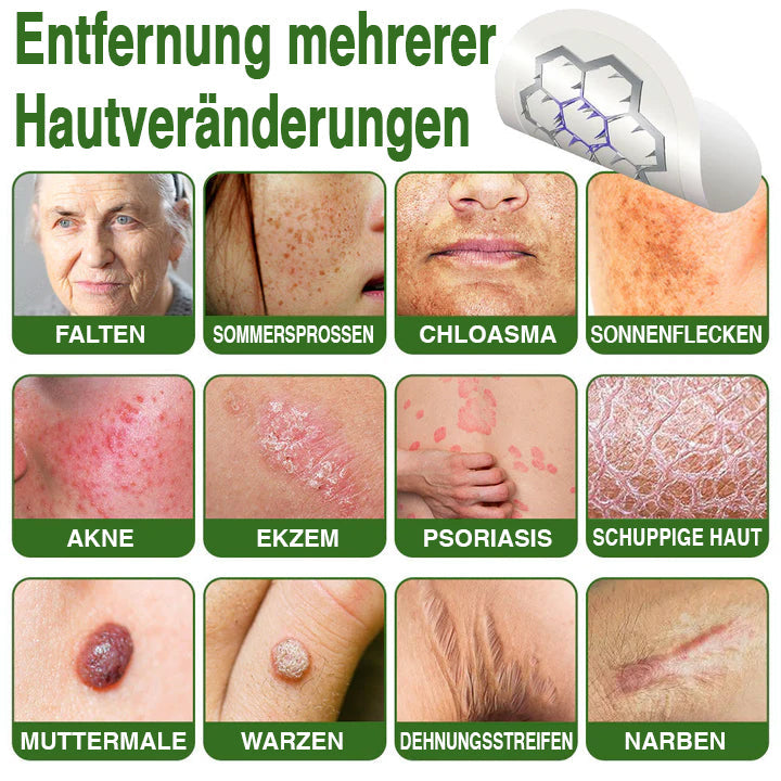 GFOUK® Magnesium Mikronadel-Pflaster zur schnellen Entfernung von Stielwarzen 🇩🇪 Hergestellt in Deutschland