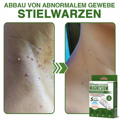 GFOUK® Magnesium Mikronadel-Pflaster zur schnellen Entfernung von Stielwarzen 🇩🇪 Hergestellt in Deutschland