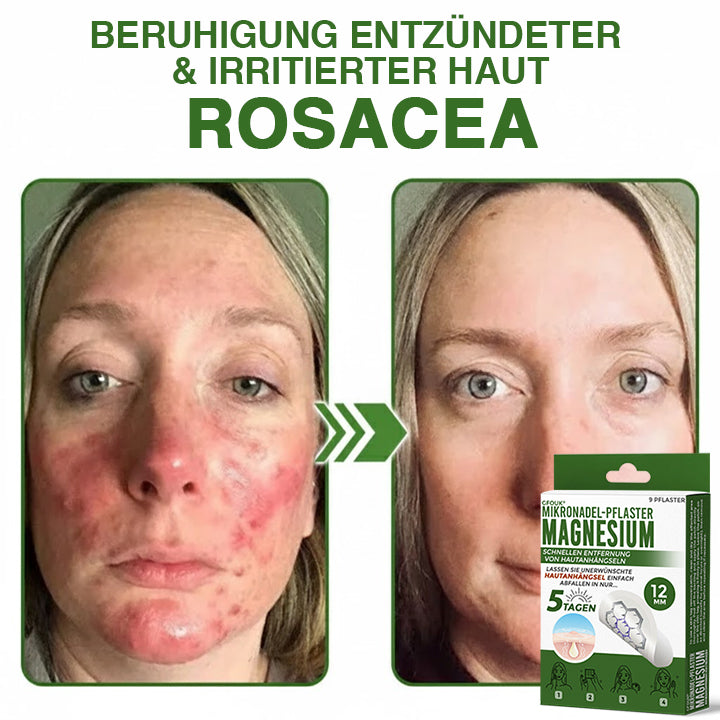 GFOUK® Magnesium Mikronadel-Pflaster zur schnellen Entfernung von Stielwarzen 🇩🇪 Hergestellt in Deutschland