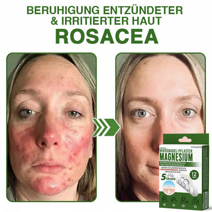 GFOUK® Magnesium Mikronadel-Pflaster zur schnellen Entfernung von Stielwarzen 🇩🇪 Hergestellt in Deutschland