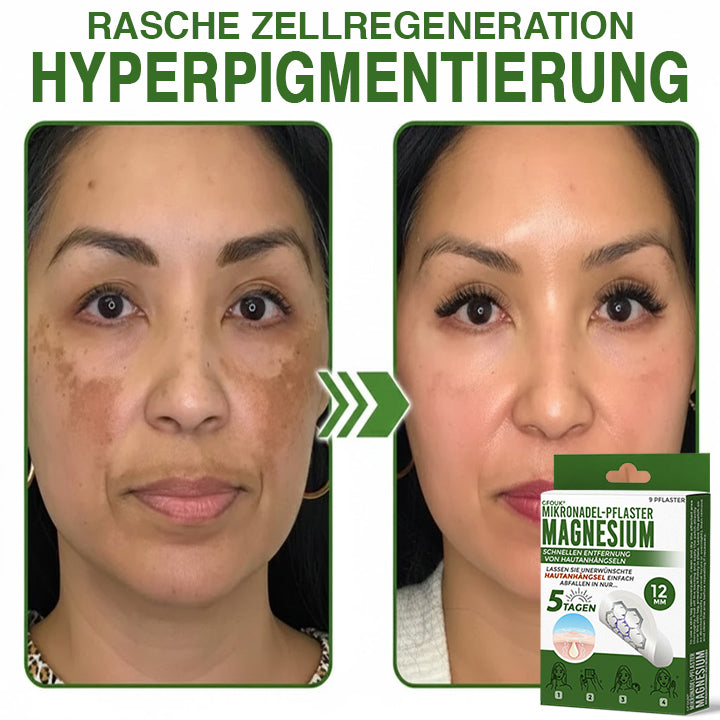 GFOUK® Magnesium Mikronadel-Pflaster zur schnellen Entfernung von Stielwarzen 🇩🇪 Hergestellt in Deutschland