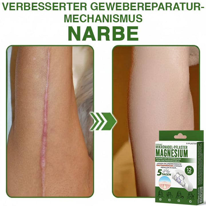 GFOUK® Magnesium Mikronadel-Pflaster zur schnellen Entfernung von Stielwarzen 🇩🇪 Hergestellt in Deutschland