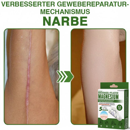 GFOUK® Magnesium Mikronadel-Pflaster zur schnellen Entfernung von Stielwarzen 🇩🇪 Hergestellt in Deutschland