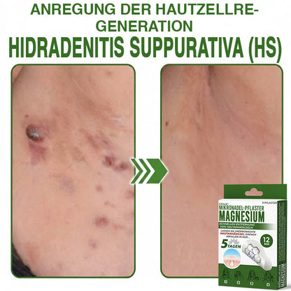 GFOUK® Magnesium Mikronadel-Pflaster zur schnellen Entfernung von Stielwarzen 🇩🇪 Hergestellt in Deutschland