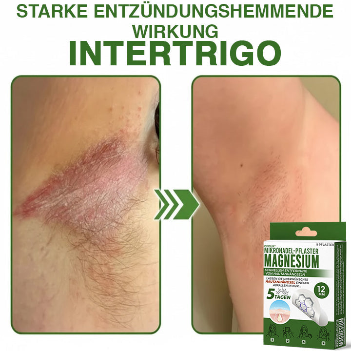 GFOUK® Magnesium Mikronadel-Pflaster zur schnellen Entfernung von Stielwarzen 🇩🇪 Hergestellt in Deutschland