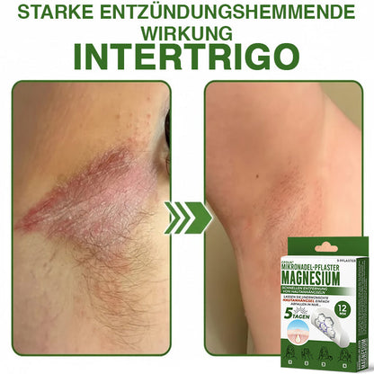 GFOUK® Magnesium Mikronadel-Pflaster zur schnellen Entfernung von Stielwarzen 🇩🇪 Hergestellt in Deutschland