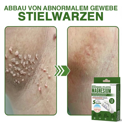 GFOUK® Magnesium Mikronadel-Pflaster zur schnellen Entfernung von Stielwarzen 🇩🇪 Hergestellt in Deutschland