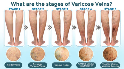 GFOUK® VenaRestore Mikronadel-Pflaster zur Venenreparatur